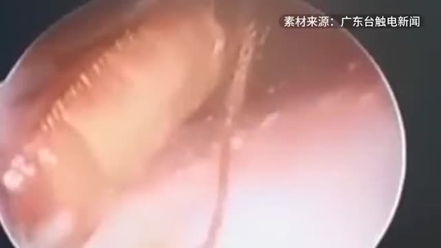 蟑螂进入男子耳道医生麻药迷晕后取出