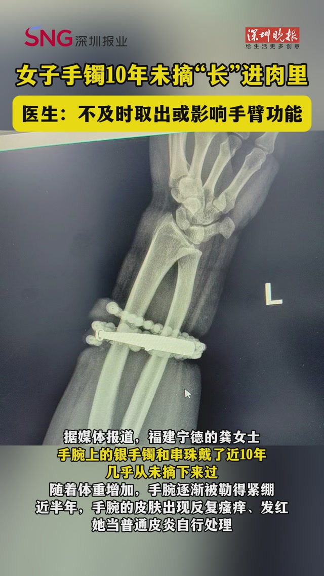 女子手镯10年未摘“长”进肉里！医生：不及时取出或影响手臂功能