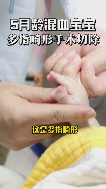 5月龄混血宝宝，多指畸形手术切除